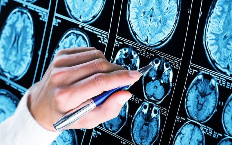 un-nou-instrument-de-inteligenta-artificiala-detecteaza-leziuni-cerebrale-ascunse-la-copiii-cu-epilepsie